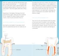 Flyer root canal treatment 4