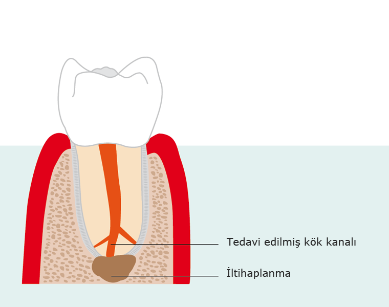 Endodontische Chirurgie Bild 9