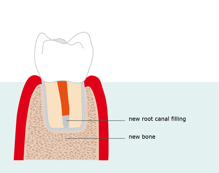 Endodontische Chirurgie Bild 13