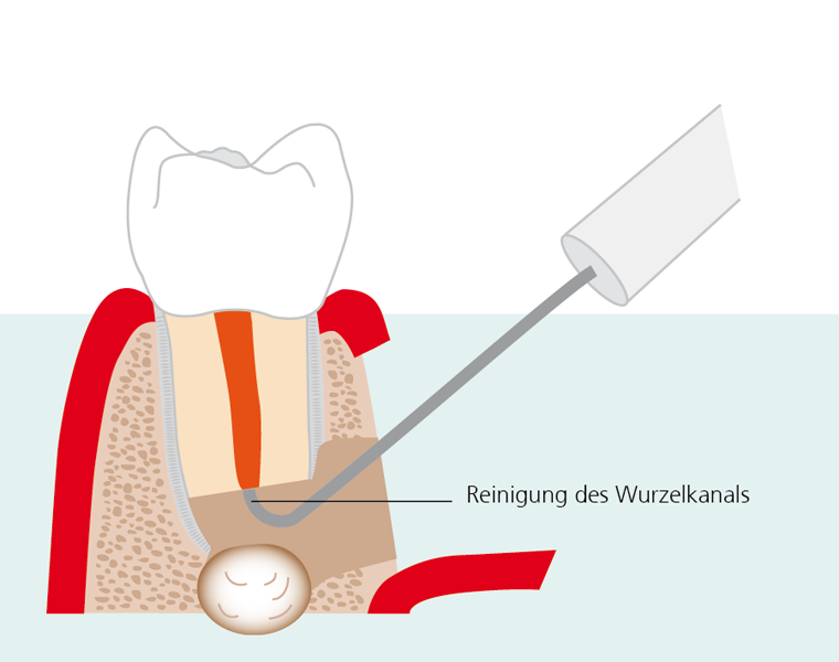 Endodontische Chirurgie Bild 11